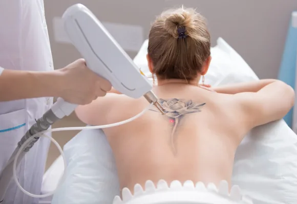 Laser-Tattoo-Removal-one-scaled-1